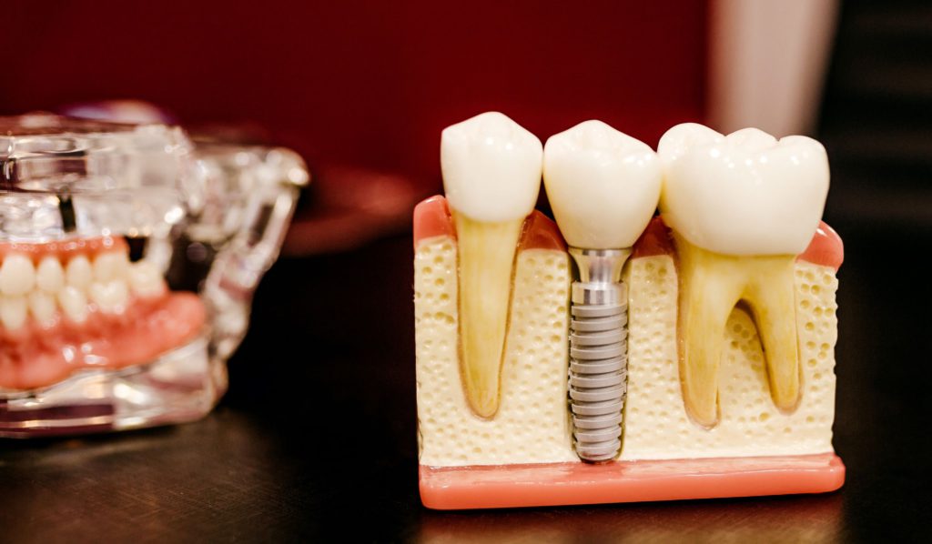 A dental implant at Dr. Joseph Dentistry