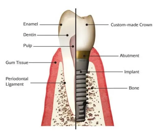 Diagram of a Dental Implants