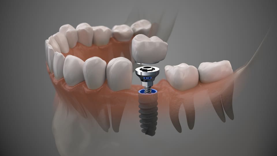 Dental Implant London Ontario