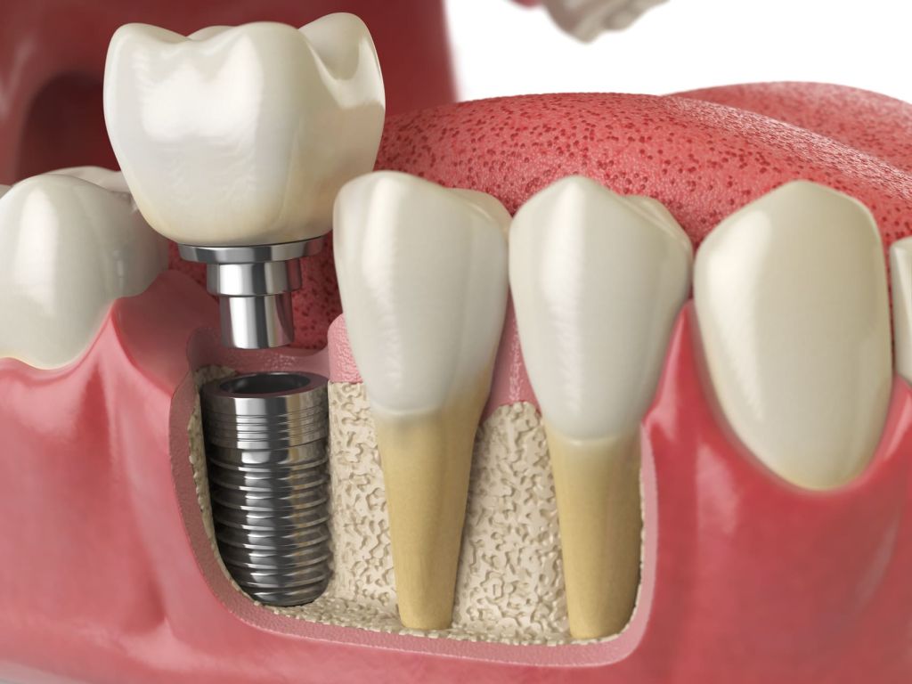 A close-up of a dental implant procedure on model illustrating how an implant integrates with the jawbone.