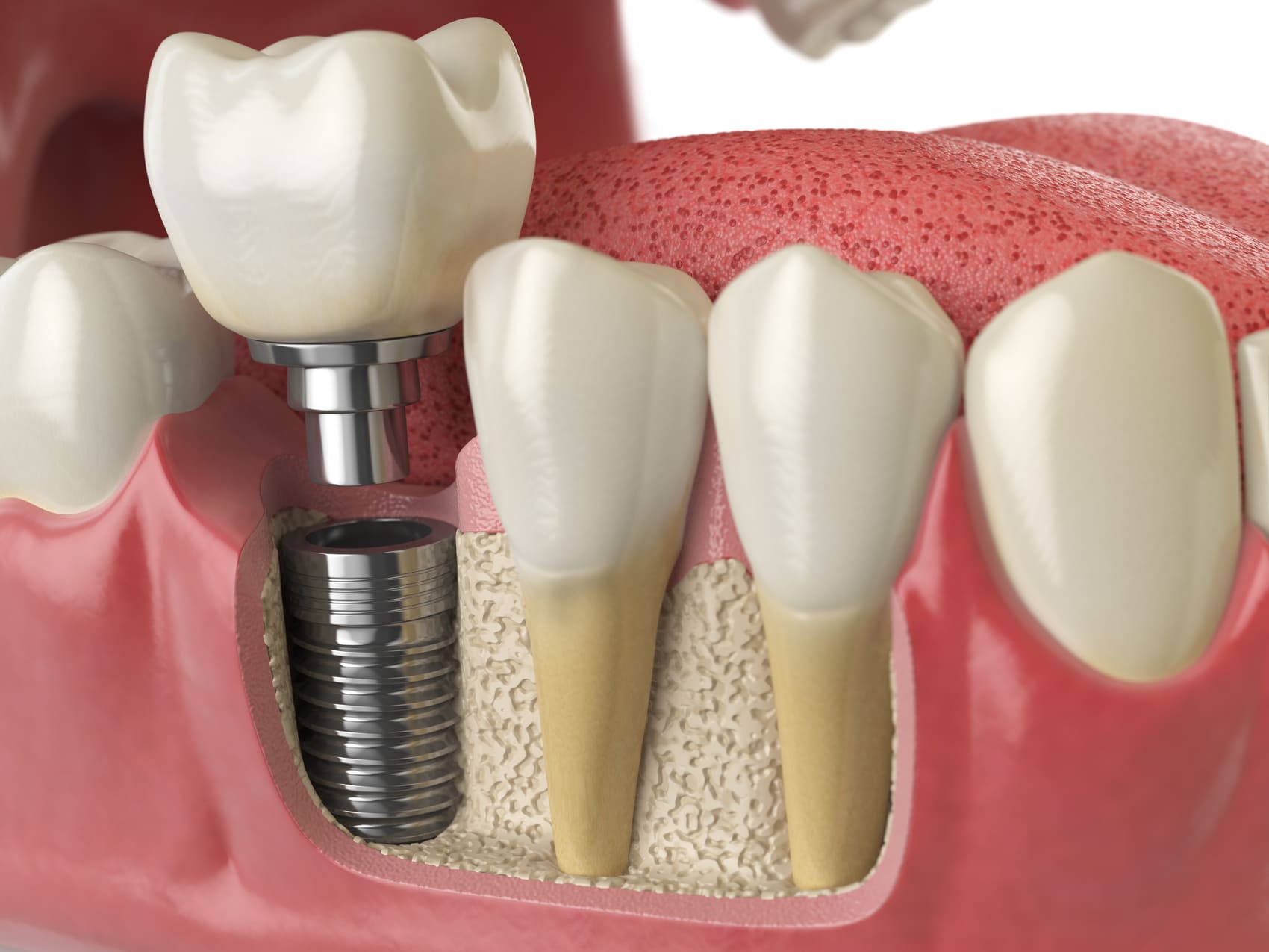 6 Ways Dental Implants Lead to the Highest Quality of Life