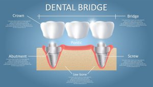 Dental Bridge Procedure