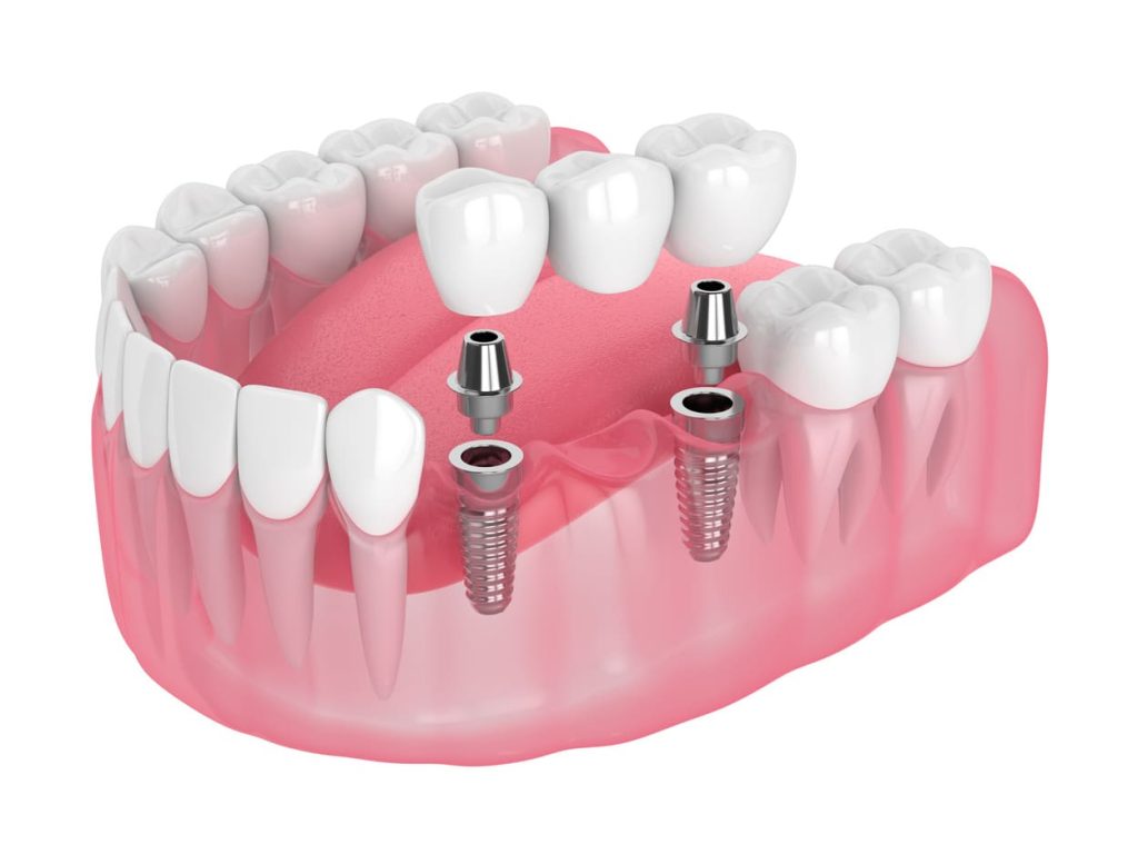 Dentures with Implants