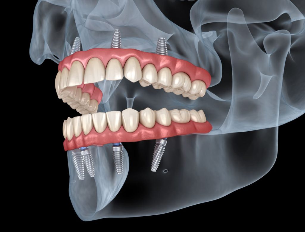 Dental Implants and Dental Bridges