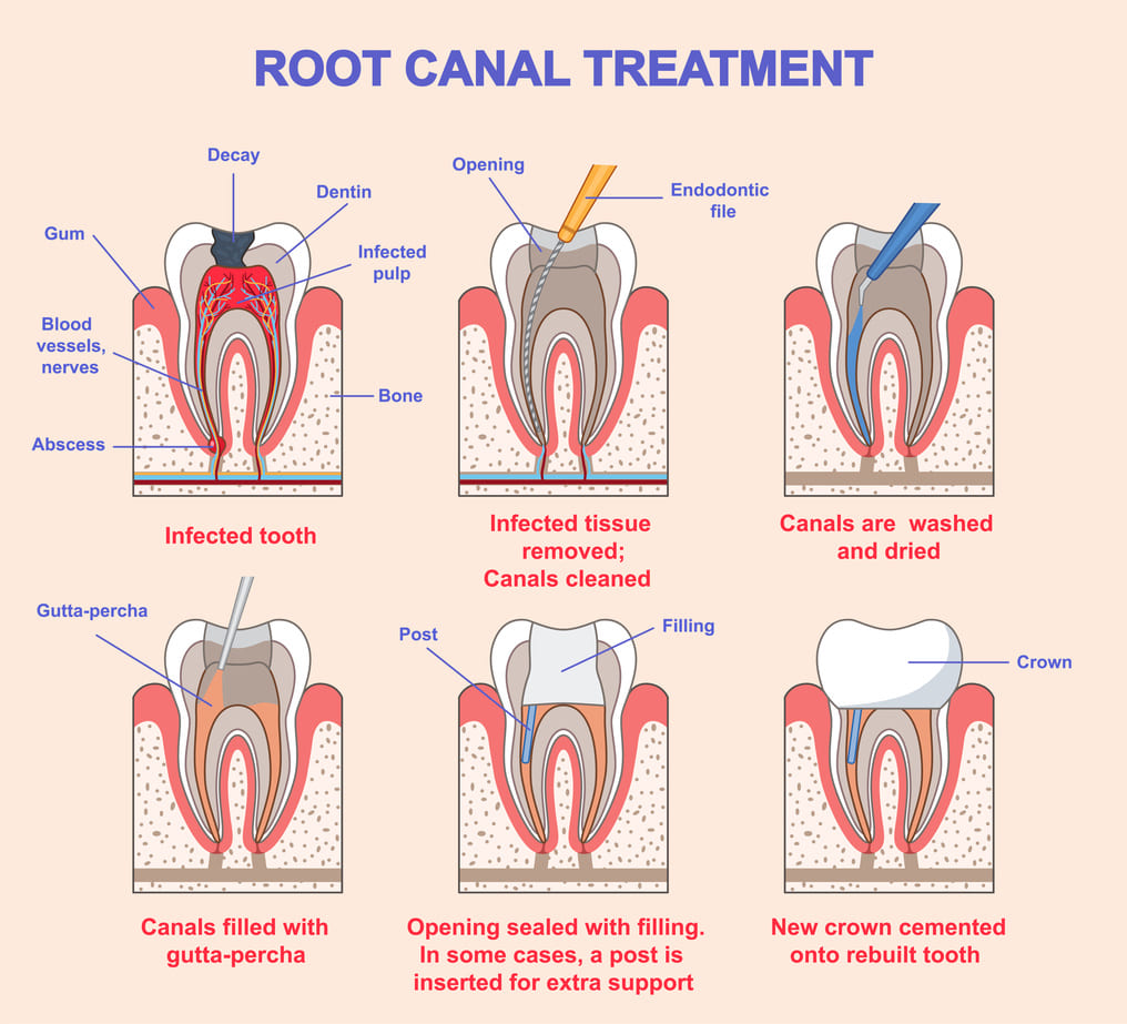 Root Canal Treatment