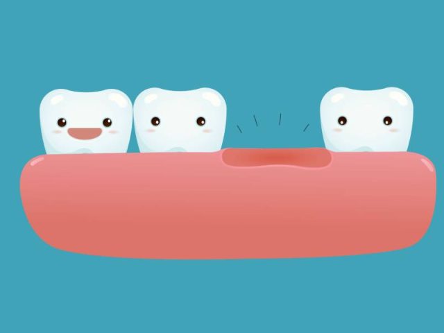 What are Your Options for Missing Teeth?