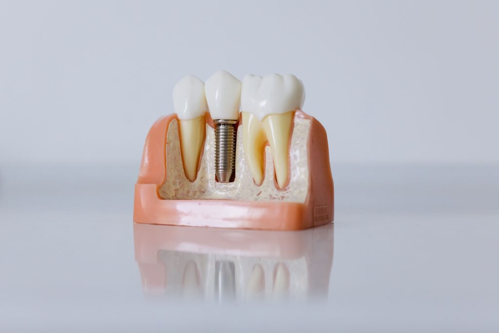 Dental Implants London Ontario