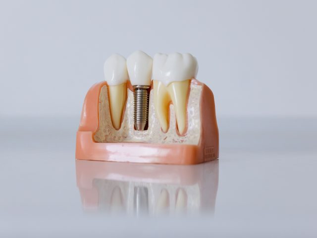 What Are Dental Implants?
