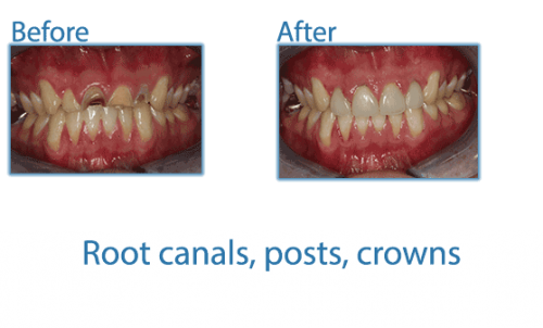 Root canals