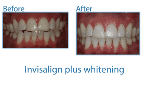 12-Invisalign-plus-whitening