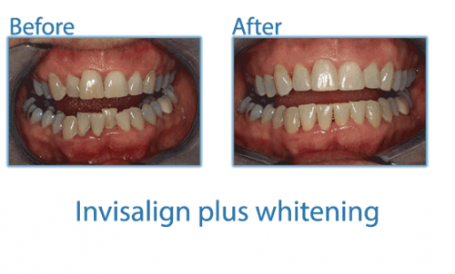 13-Invisalign-plus-whitening