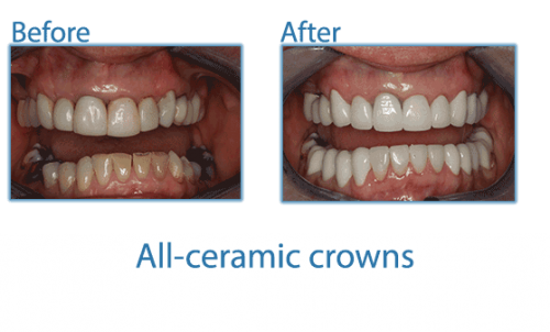all ceramic crowns dentistry