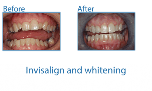 16-invisalign-and-whitening (1)