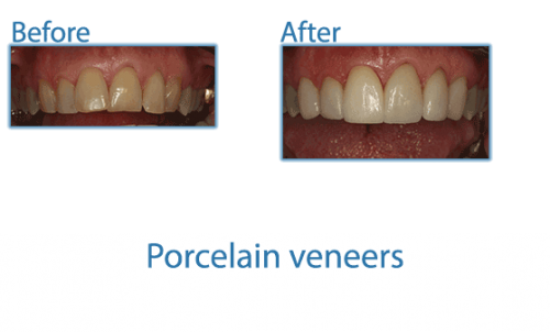 17-porcelain-veneers