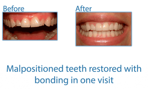 20-malpositioned-teeth-restored-with-bonding-in-one-visit.