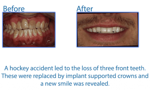 Fixing A Dental Hockey Accident