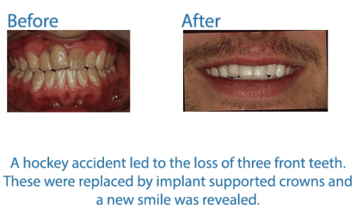 21- A hockey accident led to the loss of three front teeth. These were replaced by implant supported crowns and a new smile was revealed.