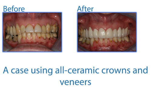 Photos depicting all ceramic crowns