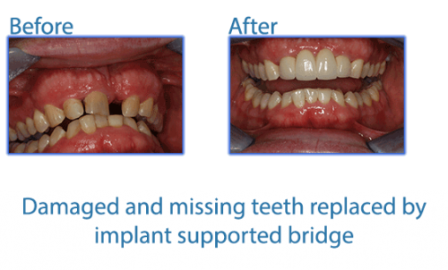 24damaged-and-missing-teeth-replaced-by-implant-supported-bridge