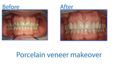 25-porcelain-veneer-makeover