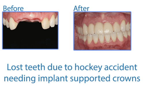 26Lost-teeth-due-to-hockey-accident-needing-implant-supported-crowns