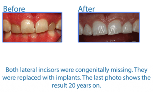 28-both-lateral-incisors-were-congenitally-missing.-They-were-replaced-with-implants.-The-last-photo-shows-the-result-20-years-on.