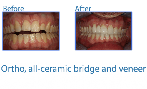 29-ortho,-all-ceramic-bridge-and-veneer
