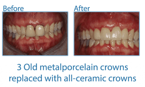 Metal Porcelain Crowns