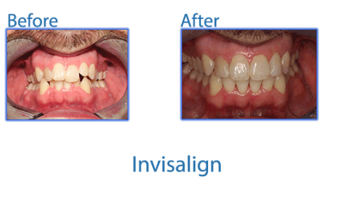 30-invisalign