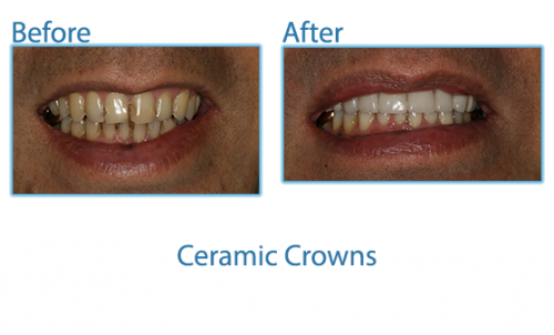 Ceramic Crowns Case