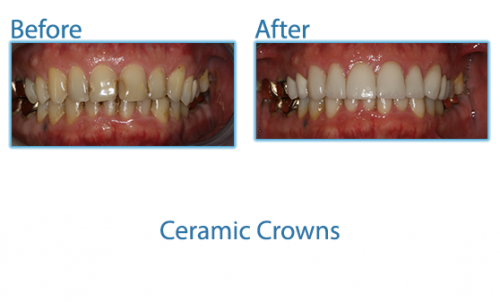 Ceramic Crowns Case Close