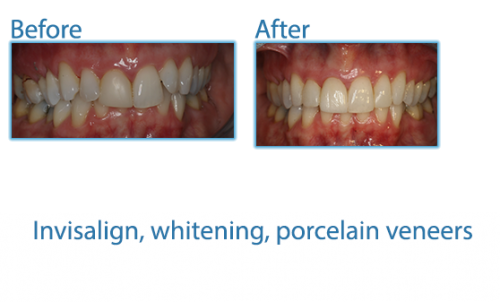 34-invisalign,-whitening,-porcelain-veneers