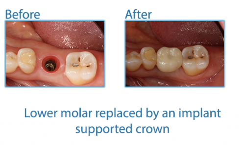 35-Lower-molar-replaced-by-an-implant-supported-crown