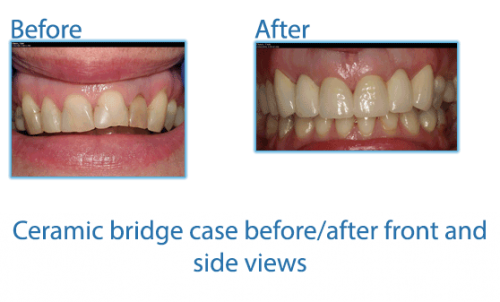36-Another-ceramic-bridge-case-before-after-front-and-side-views