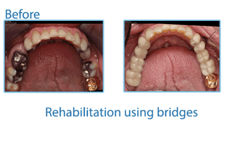 37-Rehabilitation-using-bridges