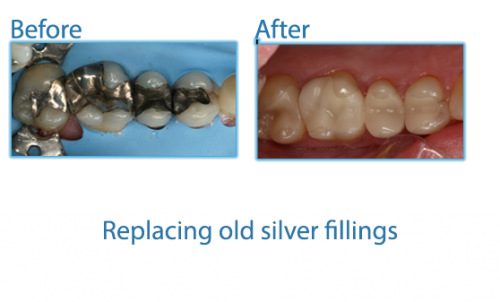 38-replacing-old-silver-fillings