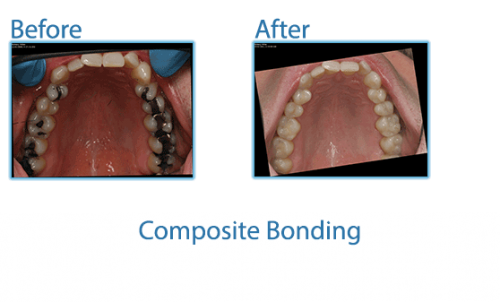 39-Composite-Bonding