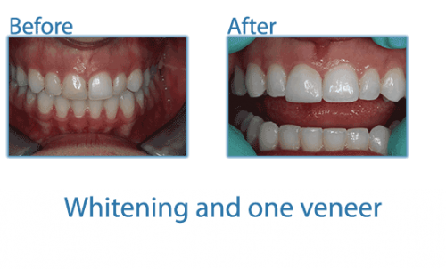 4-whitening-and-one-veneer