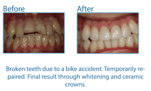 40-Broken-teeth-due-to-a-bike-accident.-Temporarily-repaired.-Final-result-through-whitening-and-ceramic-crowns.