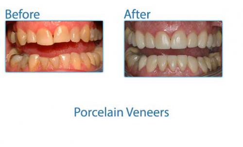 41-porcelain-veneers