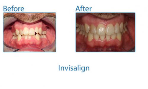 42-invisalign