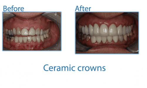 ceramic crowns pictures