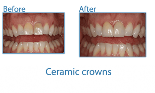 great ceramic crowns