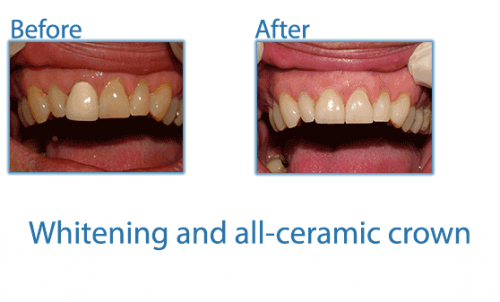 9-whitening-and-all-ceramic-crown (2)